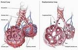 Photos of Advanced Lung Disease Symptoms