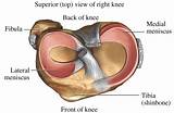 Pictures of Ligament Tear Knee Treatment Without Surgery