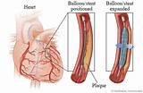 Stent Medical Definition Pictures