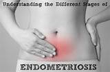 Best Fertility Treatment For Endometriosis