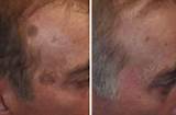 Age Spot Removal On Face Images