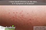 Scabies Doctor Images