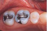 Silver Treatment For Cavities