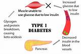 Type 2 Diabetes Medication That Helps With Weight Loss Pictures