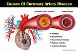 Images of What Can Cause Coronary Artery Disease