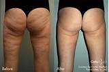 Photos of Cellulite Treatment San Francisco