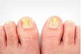 Photos of Top Home Remedies For Toenail Fungus