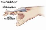 Photos of Hyperextended Thumb Treatment