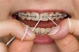 How To Clean Orthodontic Retainers Images