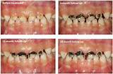 Silver Nitrate In Dentistry Photos