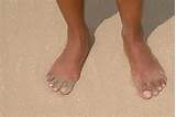 What Is Flat Feet