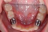 Pediatric Stainless Steel Crowns Images