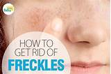 How To Get Rid Of Freckles Laser Treatment Photos