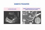Photos of Ivf Embryo Transfer
