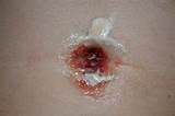 Images of Belly Button Infection Home Remedies