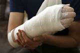 Photos of Broken Wrist Rehabilitation