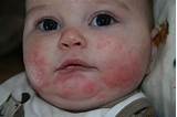Baby Food Allergy Treatment Photos