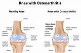 Images of Exercises Knee Osteoarthritis