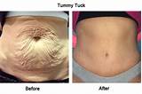 Pictures of Belly Fat Laser Treatment Cost
