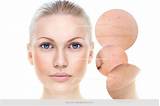 Face Makeup For Acne Prone Skin Photos
