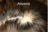 Photos of Alopecia Doctor