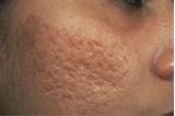 Photos of Laser Treatment For Pimple Scars