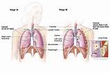 Genetic Lung Cancer Treatment