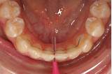 Orthodontic Retainer Repair Images