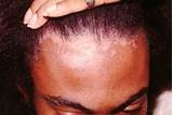 Eczema On Forehead Treatment Photos