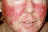 Pictures of What Kind Of Doctor For Herpes