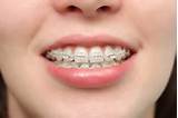 Pictures of Price Of Braces