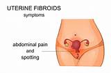 Can Fibroids Cause Pain In Your Side Images