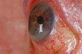 Corneal Hydrops Treatment Images