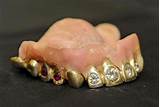 Gold Teeth Dentures
