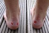 Images of How Do You Prevent Blisters From New Shoes