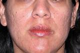 Photos of Laser Treatment For Pimple Scars