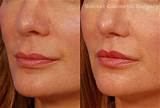 Images of Lip Reduction Surgery Recovery Time