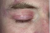 Pictures of Seborrheic Dermatitis Eyelids Treatment