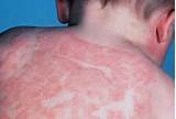Photos of Home Remedies Atopic Dermatitis