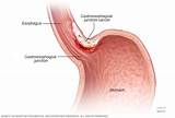 Photos of Gastroesophageal Junction Cancer Treatment