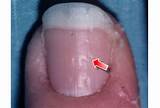 Images of Nail Pitting Treatment