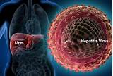 Photos of Treatment For Hep B Infection