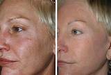 Laser Treatment For Skin Cancer On Face Photos