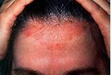 Pictures of Dandruff Doctor Dermatologist