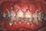 Photos of Gum Inflammation Medication