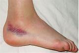 Swollen Ankle Sprain Treatment Images