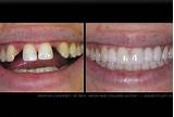 Dental Loans For Dentures Images