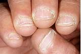 Bad Fingernails Treatment Photos