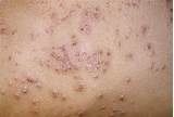 Eczema On Back Treatment Photos