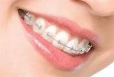 What Is The Price For Braces Images